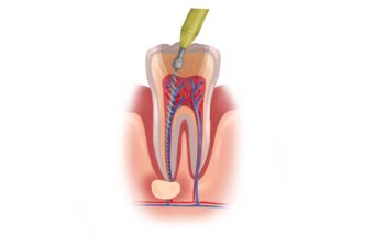 What is a Root Canal and When Do You Need One? Mooresville, NC